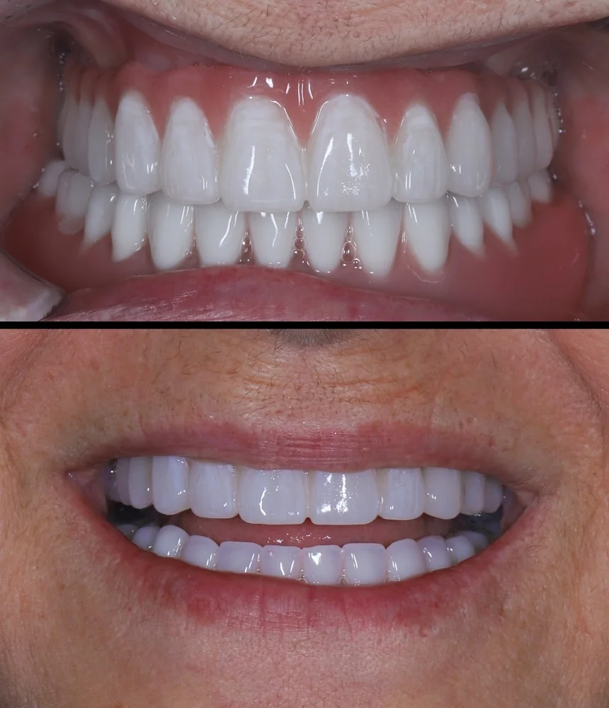 Full-Mouth Reconstruction park city